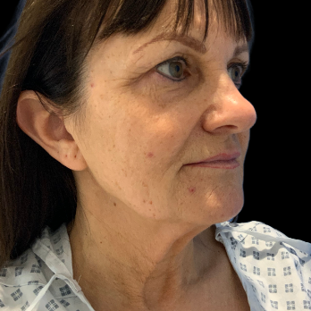 before-deep-plane-facelift-necklift